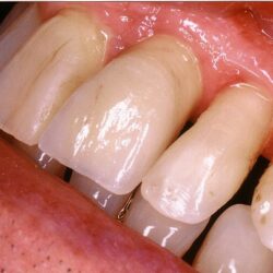 ceramica-metalo-13