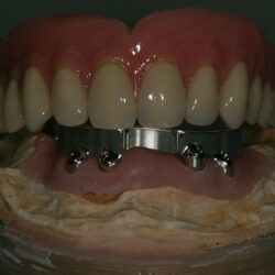 overdenture001