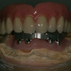 overdenture001