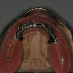 overdenture004