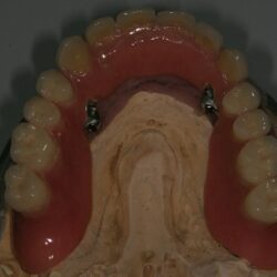 overdenture005