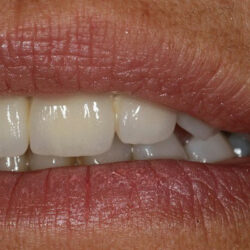 zirconia1