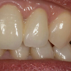 zirconia2