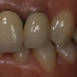 zirconia3