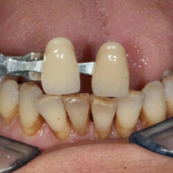 zirconia5