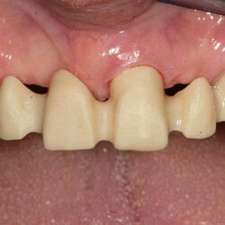 zirconia6